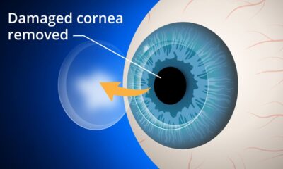 Corneal