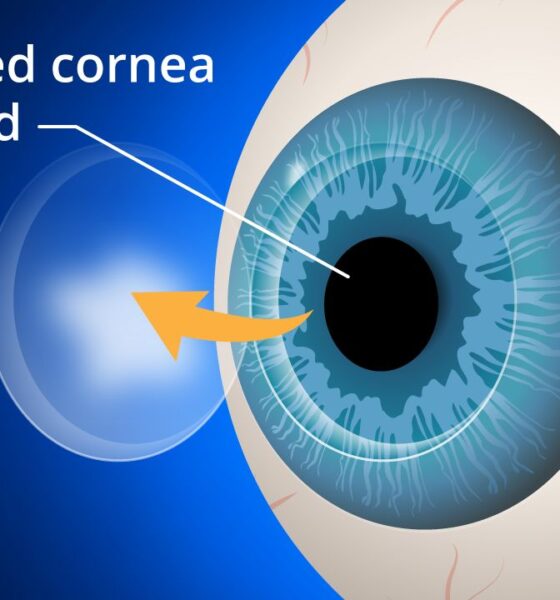 Corneal