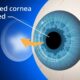 Corneal