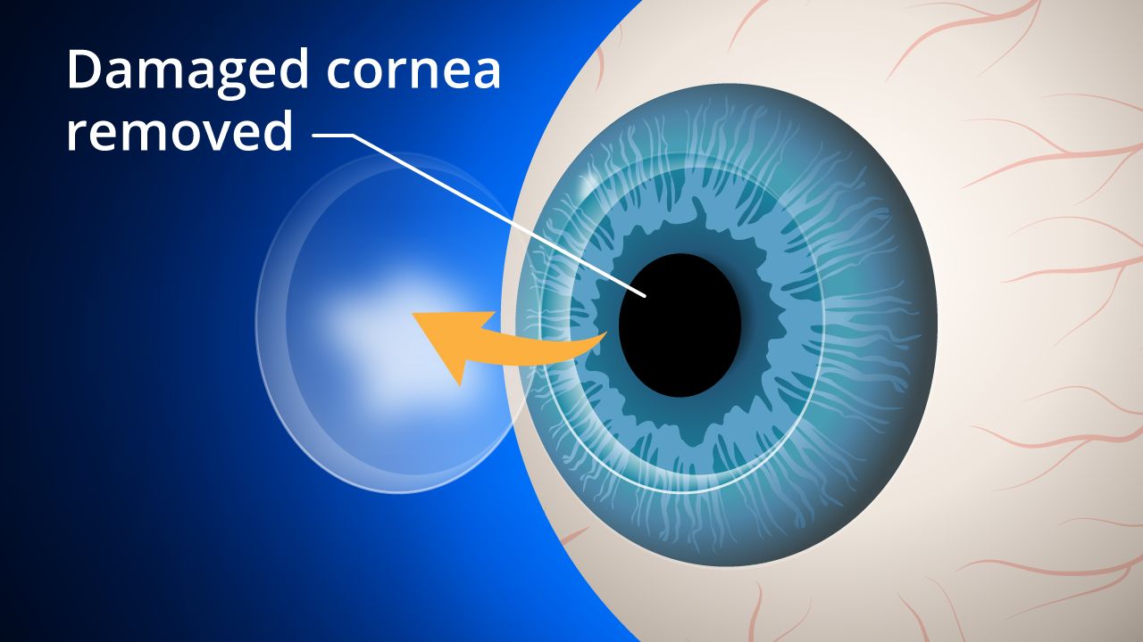 Corneal